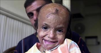 Badly Scarred Young Girl Receives Care After Mother’s Selfless Sacrifice